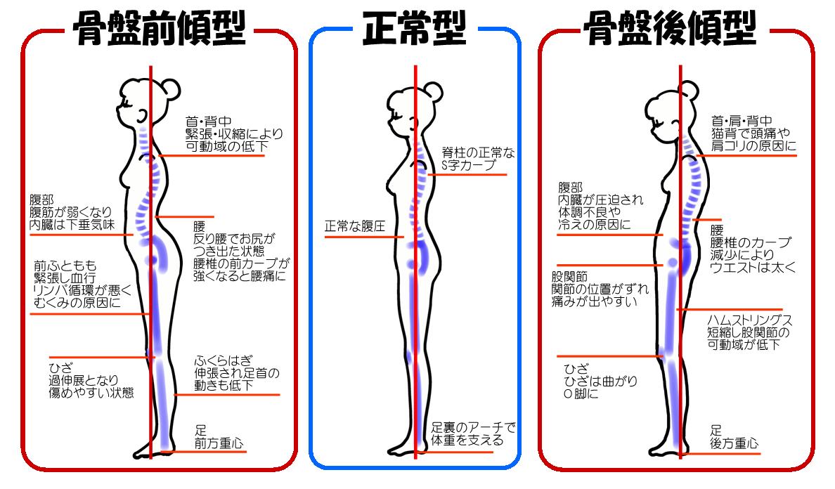 反り腰・出っ尻からくる腰痛と改善方法