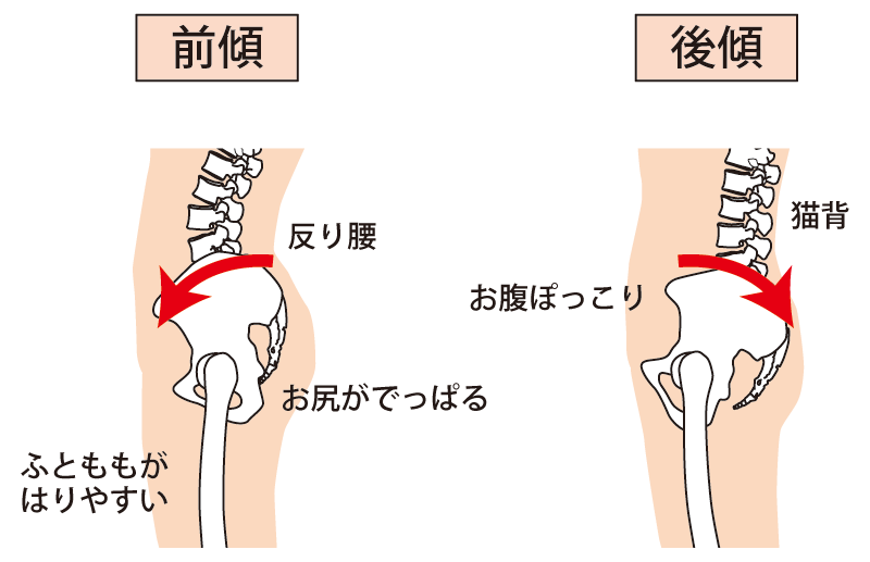 なぜ反り腰・出っ尻になるのか ― 骨格から見た原因