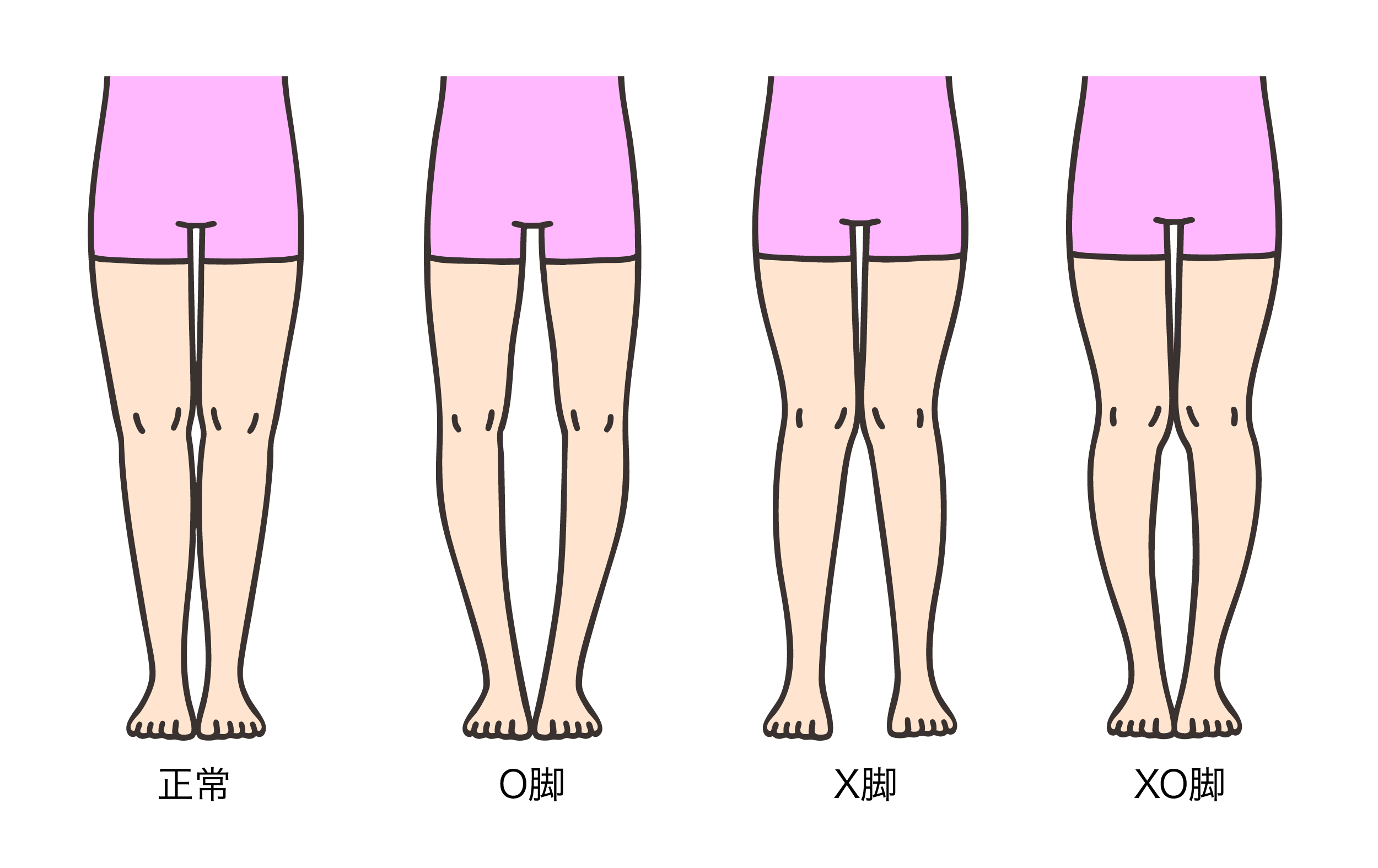 Ｏ脚・がに股が気になる女性へ