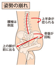 足組みで骨盤が歪み、右足が開き腰痛に