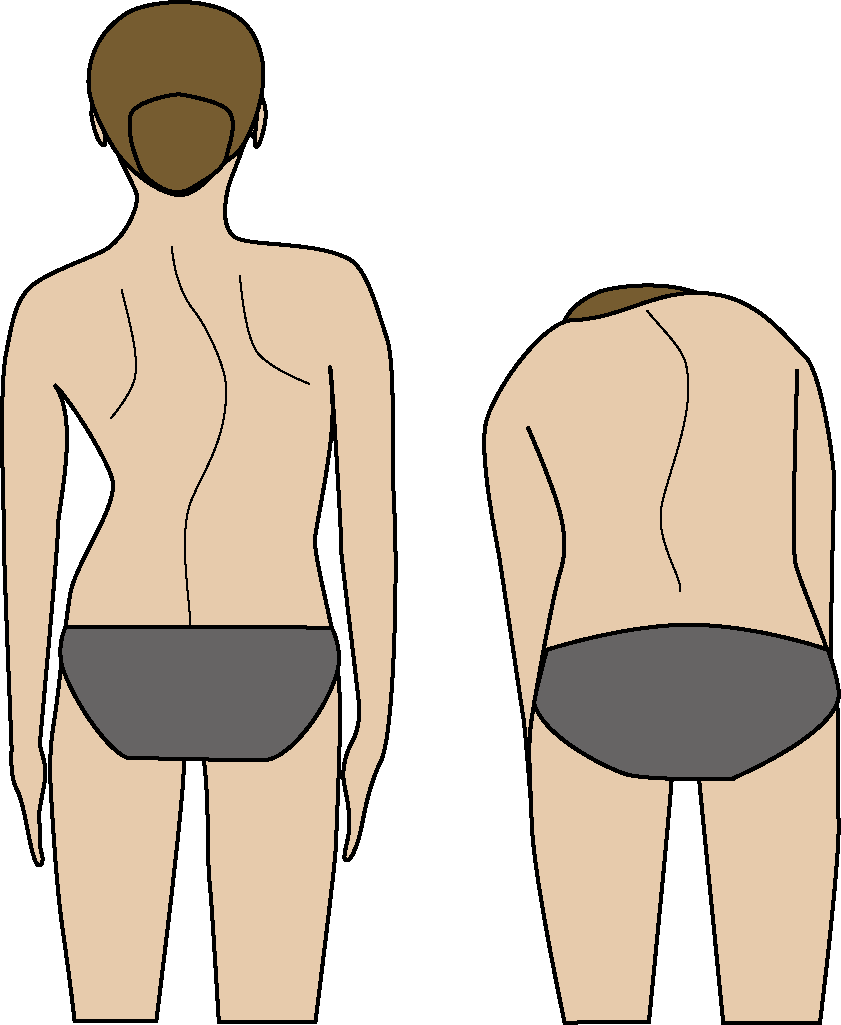 側弯症セルフチェック表

チェック項目　/　チェック欄