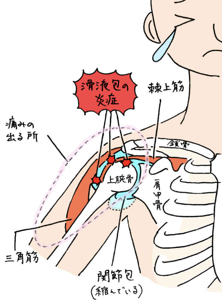 五十肩は、加齢や姿勢の肩関節の(関節包・腱・滑液包など)に炎症が生じ、可動域が制限。肩を上げたり後ろに回したりと動作が困難。