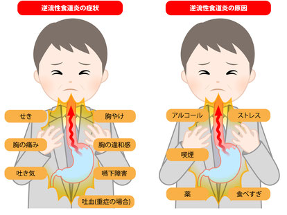 胃痛・逆流性食道炎は、首と横隔膜の硬さ、自律神経の関係
