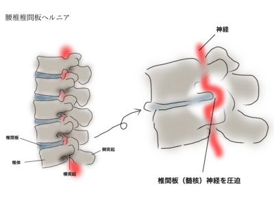 腰椎椎間板ヘルニア|高崎市整体ゆあさで多い腰痛・しびれの原因とは