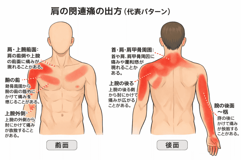 肩の関連痛の出方(代表パターン)