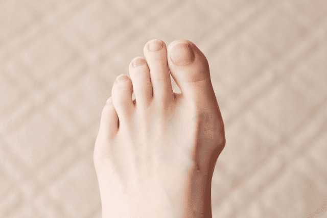 外反母趾を気にしている女性の趾の様子
